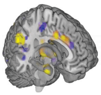 Image: Functional magnetic resonance imaging (fMRI) brain scan shows the neurologic signature for physical pain identified in a new study (Photo courtesy of Tor Wager, CU-Boulder).